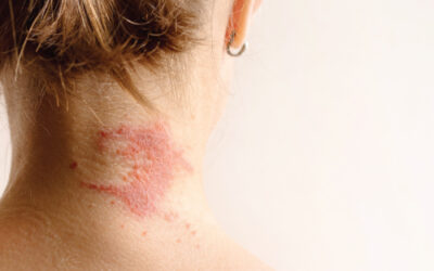 Exploring Treatment Options for Severe Eczema
